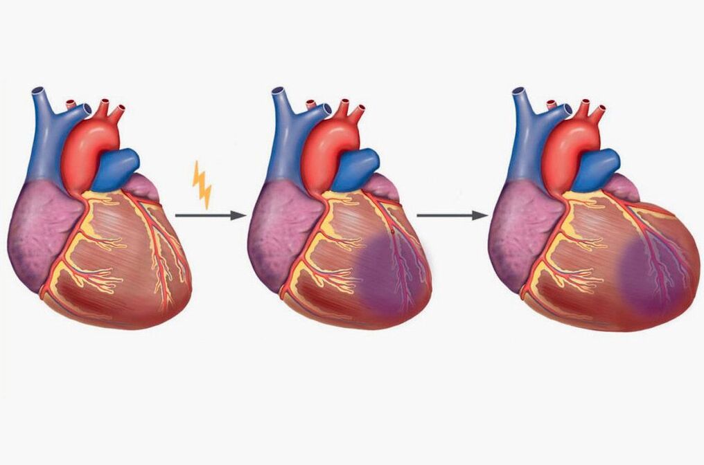 Miocardial infarction nyorisi si irora ninu awọn ejika abe
