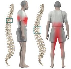 Irora pẹlu chedroracic chedrocic le wa ni fifun si awọn ọwọ isalẹ ati crotch