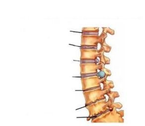 Awọn aami aisan ti osteochondrosis