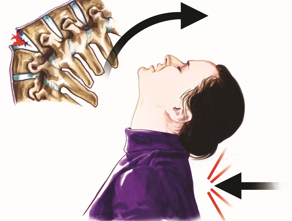 ibajẹ ọpa ẹhin bi idi ti irora ọrun