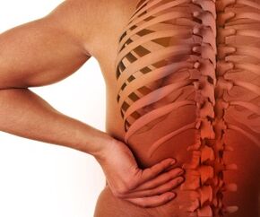 irora pada pẹlu lumbar osteochondrosis