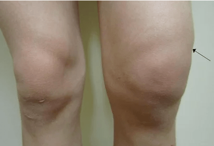 Hemarthrosis ti isẹpo orokun